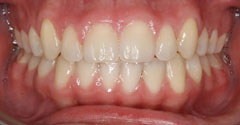 , Before and After Orthodontic Treatments in Austin, TX