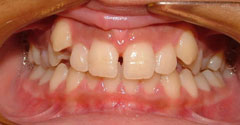 , Before and After Orthodontic Treatments in Austin, TX