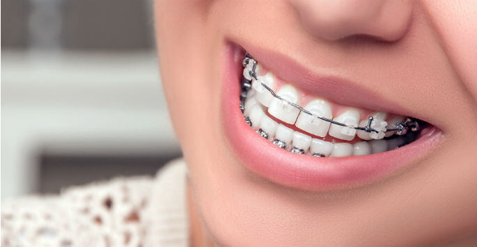 Getting Started with Adult Orthodontics - Central Texas Orthodontics