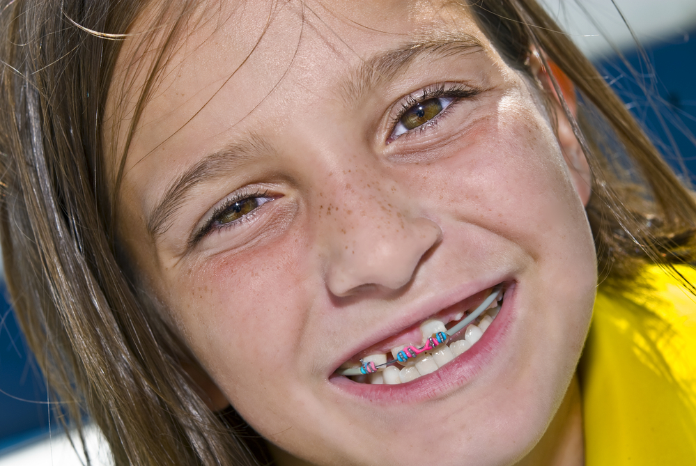 braces for adults Braces For Kids 5