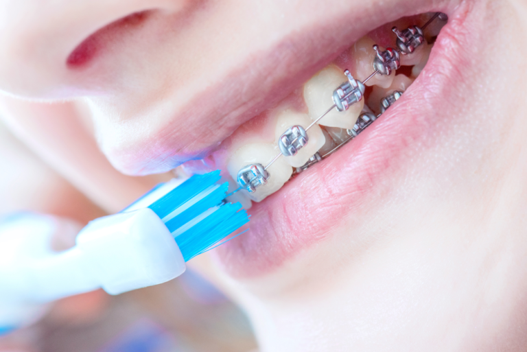 How Do SelfLigating Braces Work? Central Texas Orthodontics