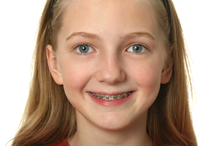 Braces for Children FAQs: How Do I Prepare My Child for Getting Braces