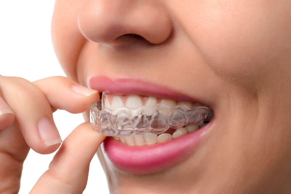 How Long Do You Really Have to Wear a Retainer?, Byte®