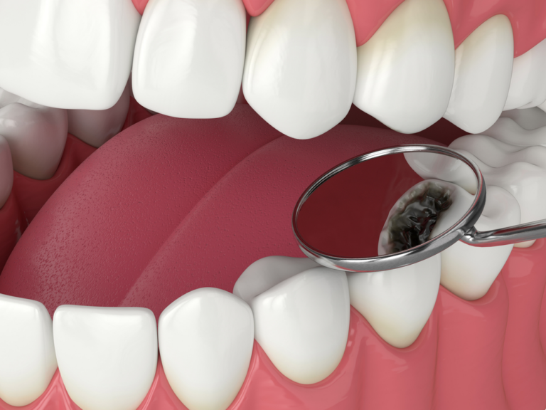 What Are the Most Important Steps for Cavity Prevention? - Central ...